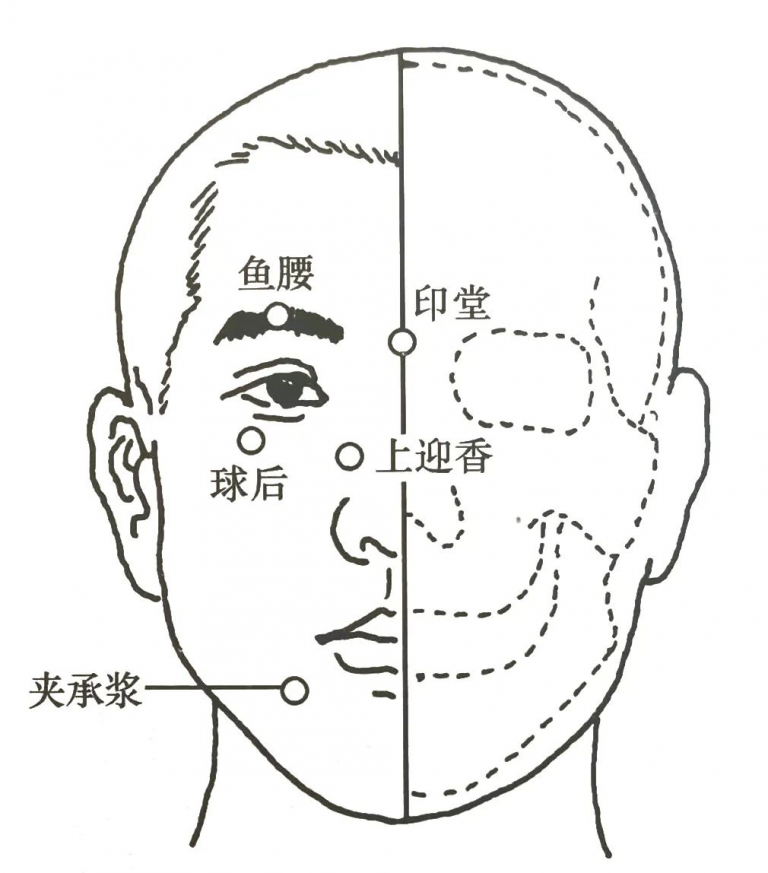 4种临床常见痛证的一针疗法 - 中医农业实践者